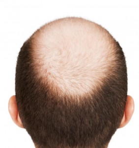 picture of male pattern baldness picture of male pattern baldness