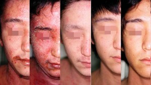 picture of man with steroidacne picture of man with steroidacne