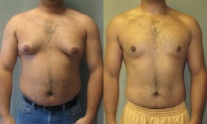 Gynecomastia, or the development of female breasts in men, is a severe but common risk of steroid use.