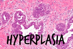 gynecomastoid_hyperplasia