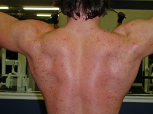 steroid acne